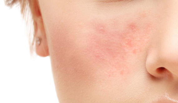 Autoimmune Diseases