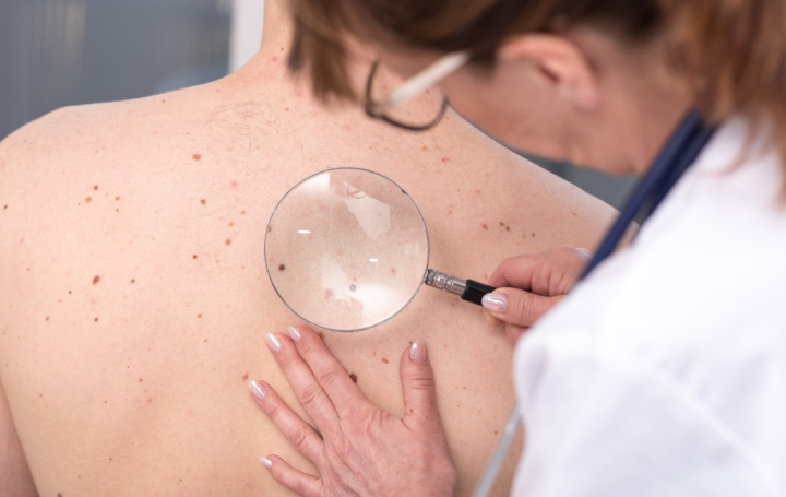 Skin Cancer Skin Cancer
